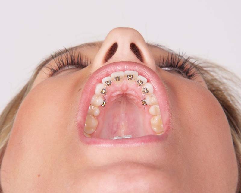 Ortodonzia linguale